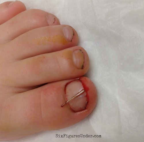 showing-how-sliver-was-under-toenail